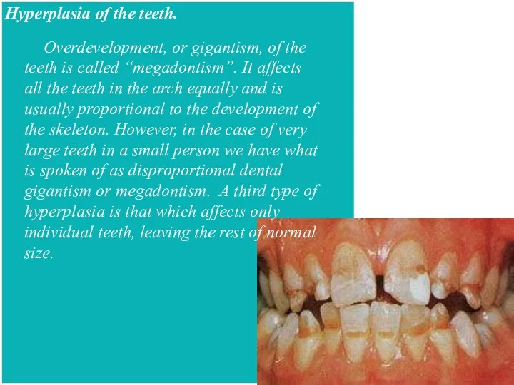 Hyperplasia of the teeth. Overdevelopment, or gigantism, of the teeth