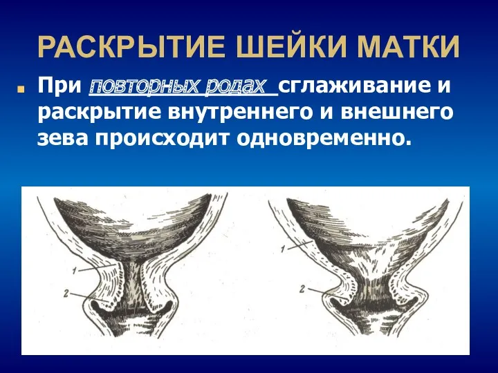 РАСКРЫТИЕ ШЕЙКИ МАТКИ При повторных родах сглаживание и раскрытие внутреннего и внешнего зева происходит одновременно.