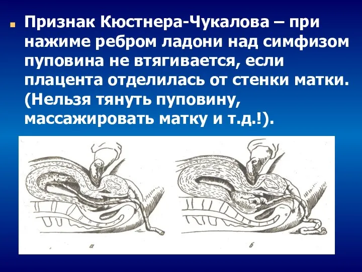 Признак Кюстнера-Чукалова – при нажиме ребром ладони над симфизом пуповина