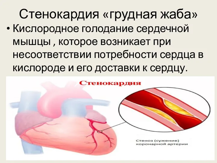 Стенокардия «грудная жаба» Кислородное голодание сердечной мышцы , которое возникает