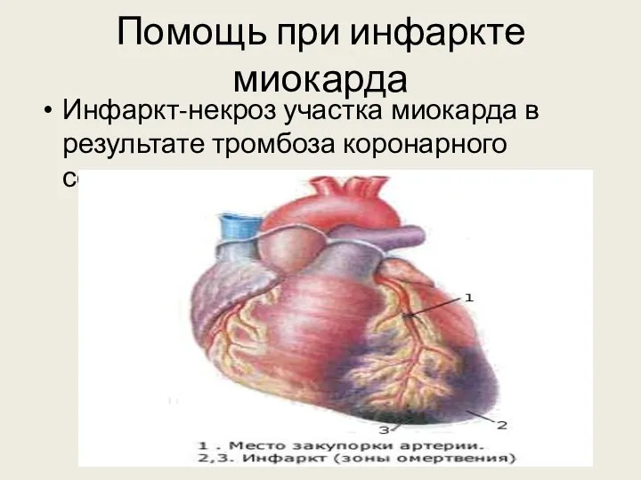 Помощь при инфаркте миокарда Инфаркт-некроз участка миокарда в результате тромбоза коронарного сосуда