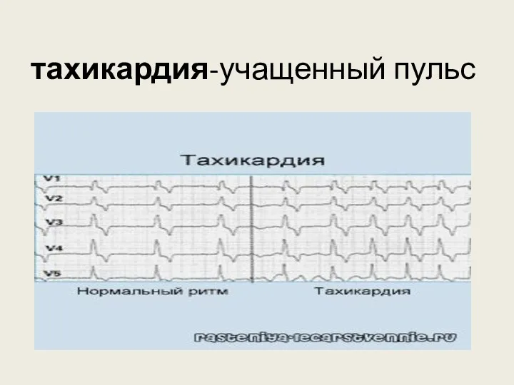 тахикардия-учащенный пульс