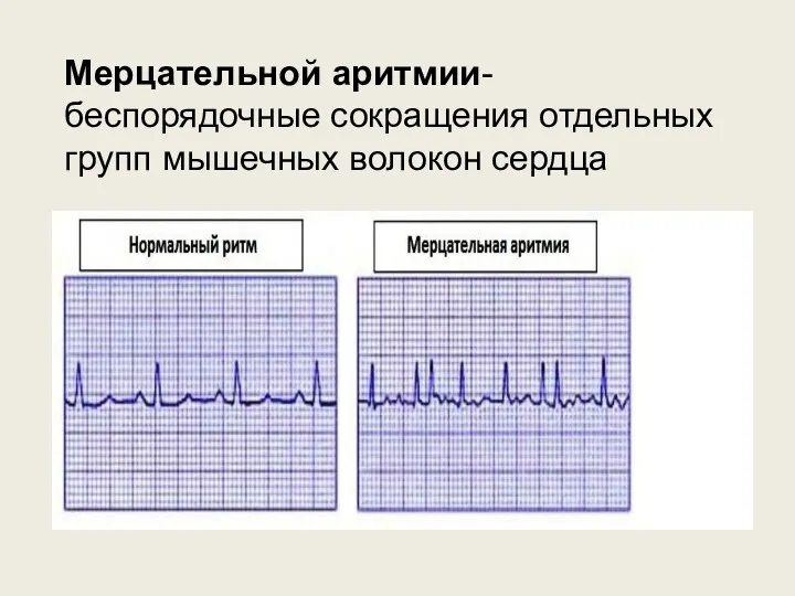 Мерцательной аритмии-беспорядочные сокращения отдельных групп мышечных волокон сердца