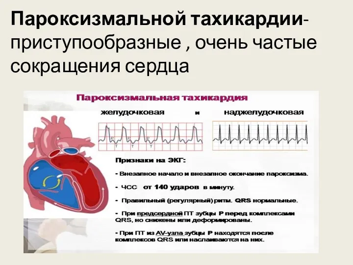 Пароксизмальной тахикардии-приступообразные , очень частые сокращения сердца