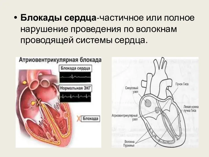 Блокады сердца-частичное или полное нарушение проведения по волокнам проводящей системы сердца.