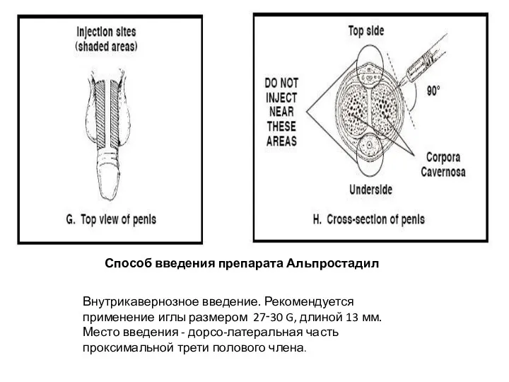 Способ введения препарата Альпростадил Внутрикавернозное введение. Рекомендуется применение иглы размером