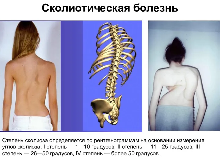 Сколиотическая болезнь Степень сколиоза определяется по рентгенограммам на основании измерения