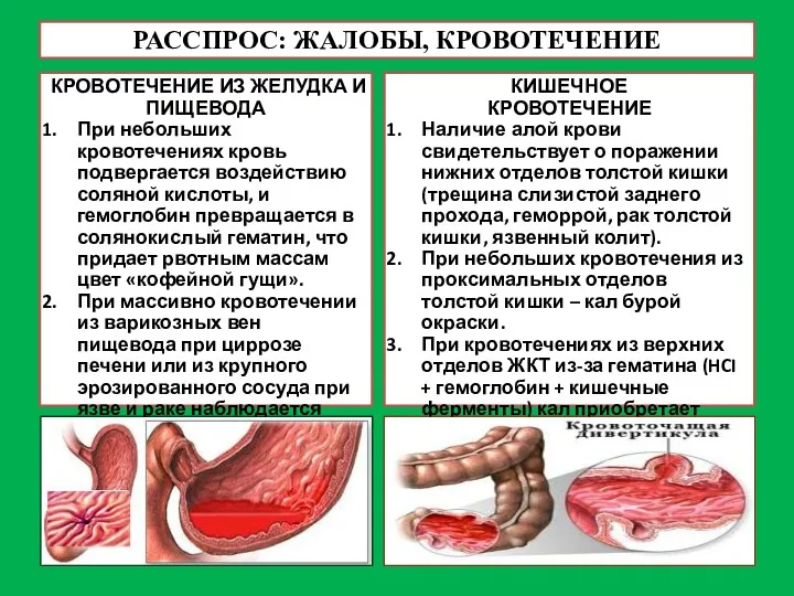 РАССПРОС: ЖАЛОБЫ, КРОВОТЕЧЕНИЕ КРОВОТЕЧЕНИЕ ИЗ ЖЕЛУДКА И ПИЩЕВОДА При небольших