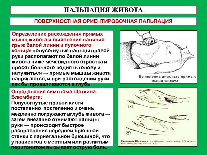 ПАЛЬПАЦИЯ ЖИВОТА ПОВЕРХНОСТНАЯ ОРИЕНТИРОВОЧНАЯ ПАЛЬПАЦИЯ Определение расхождения прямых мышц живота