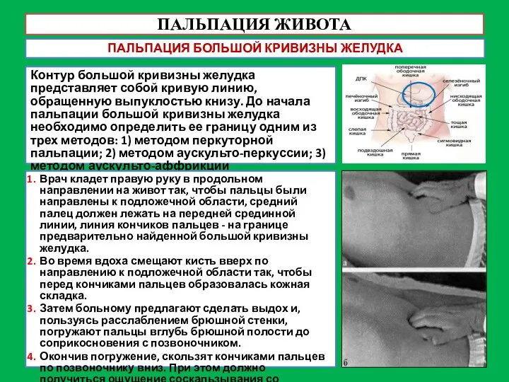 ПАЛЬПАЦИЯ ЖИВОТА ПАЛЬПАЦИЯ БОЛЬШОЙ КРИВИЗНЫ ЖЕЛУДКА Контур большой кривизны желудка