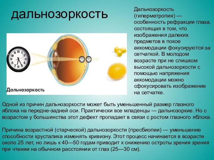 дальнозоркость Дальнозоркость (гиперметропия) — особенность рефракции глаза, состоящая в том,