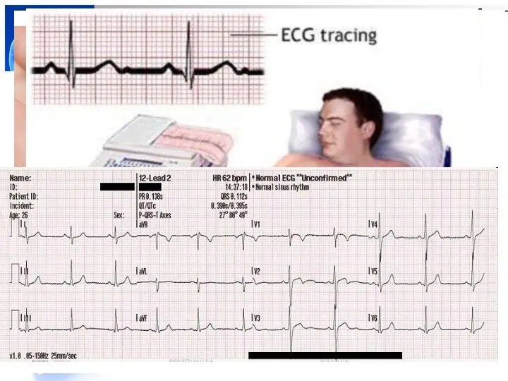 Электрокардиограмма (ЭКГ) В работающем сердце постоянно возникает смена электрических потенциалов. Биотоки сердца по
