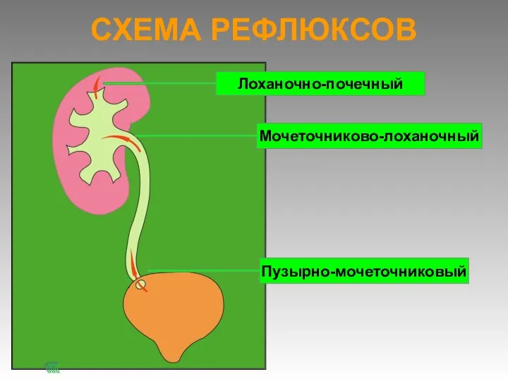 СХЕМА РЕФЛЮКСОВ Пузырно-мочеточниковый Мочеточниково-лоханочный Лоханочно-почечный