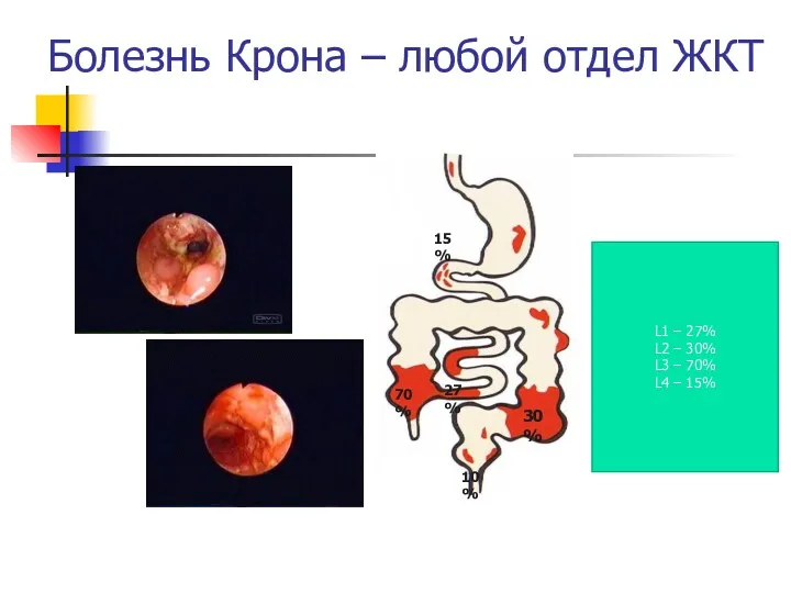 Болезнь Крона – любой отдел ЖКТ 30% 10% 15% 70%