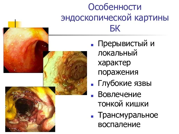 Особенности эндоскопической картины БК Прерывистый и локальный характер поражения Глубокие язвы Вовлечение тонкой кишки Трансмуральное воспаление