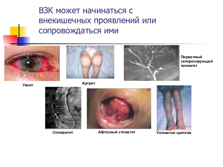 Артрит Спондилит Увеит Первичный склерозирующий холангит Узловатая эритема Афтозный стоматит