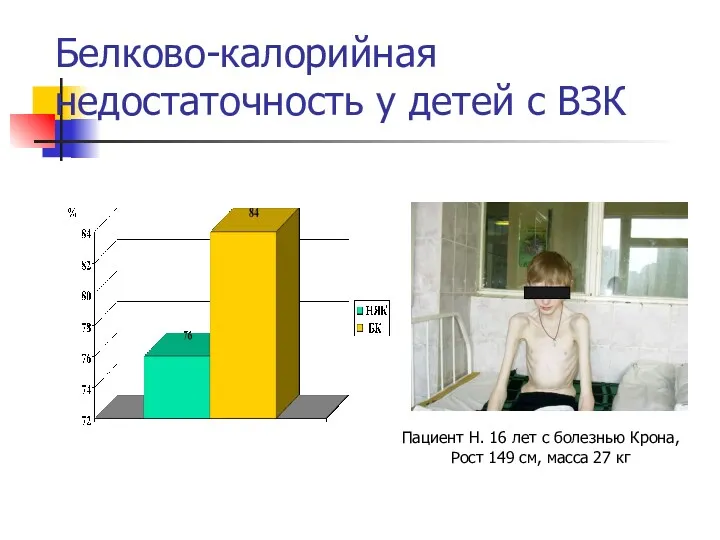 Белково-калорийная недостаточность у детей с ВЗК Пациент Н. 16 лет