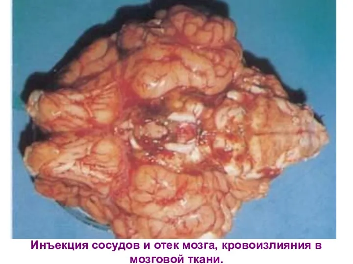 Инъекция сосудов и отек мозга, кровоизлияния в мозговой ткани.