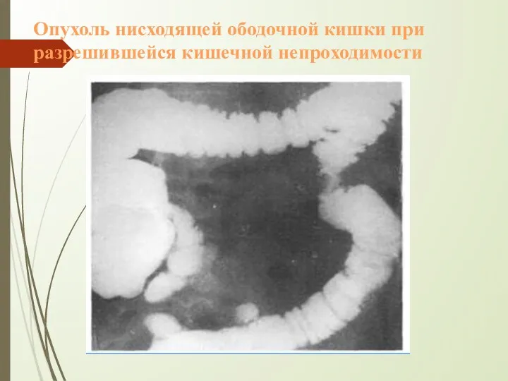 Опухоль нисходящей ободочной кишки при разрешившейся кишечной непроходимости