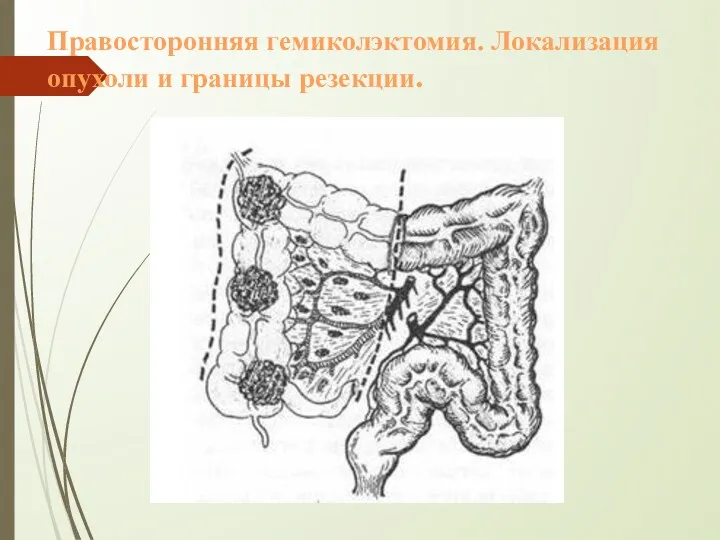 Правосторонняя гемиколэктомия. Локализация опухоли и границы резекции.