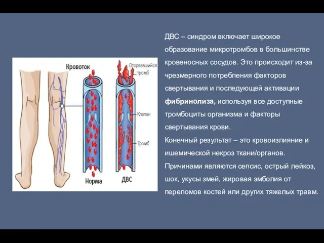 ДВС – синдром включает широкое образование микротромбов в большинстве кровеносных