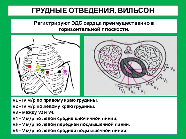 ГРУДНЫЕ ОТВЕДЕНИЯ, ВИЛЬСОН V1 – IV м/р по правому краю