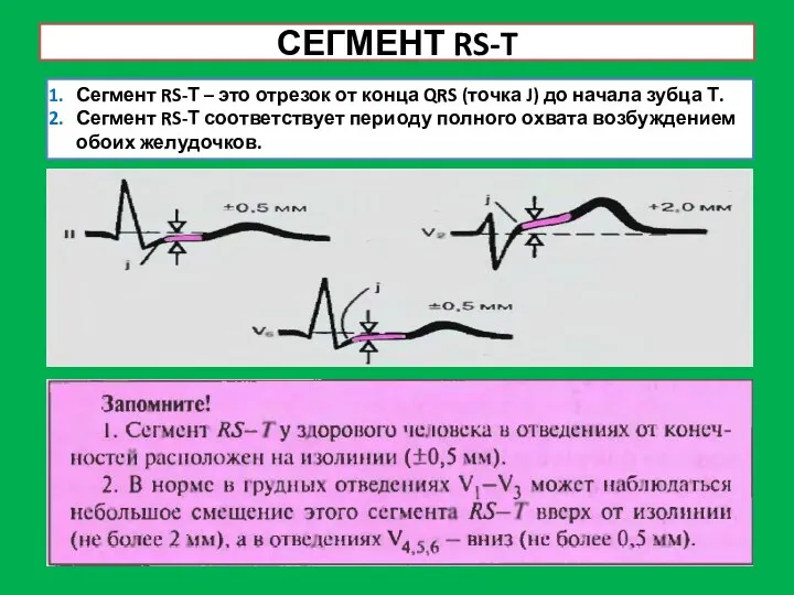 СЕГМЕНТ RS-T Сегмент RS-Т – это отрезок от конца QRS