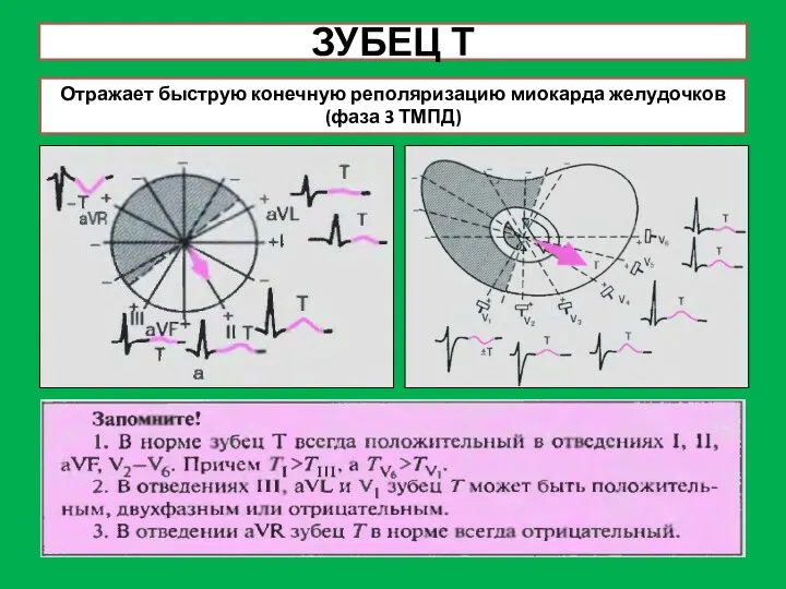 ЗУБЕЦ Т Отражает быструю конечную реполяризацию миокарда желудочков (фаза 3 ТМПД)