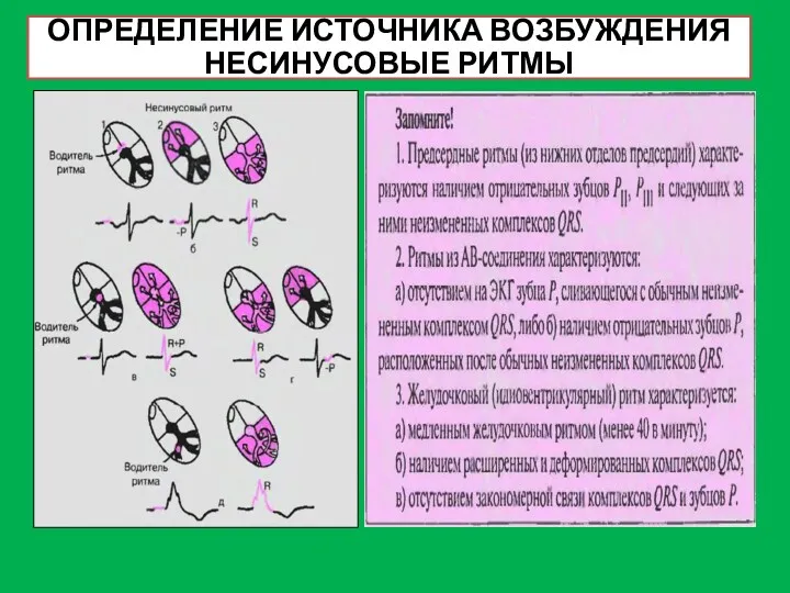 ОПРЕДЕЛЕНИЕ ИСТОЧНИКА ВОЗБУЖДЕНИЯ НЕСИНУСОВЫЕ РИТМЫ