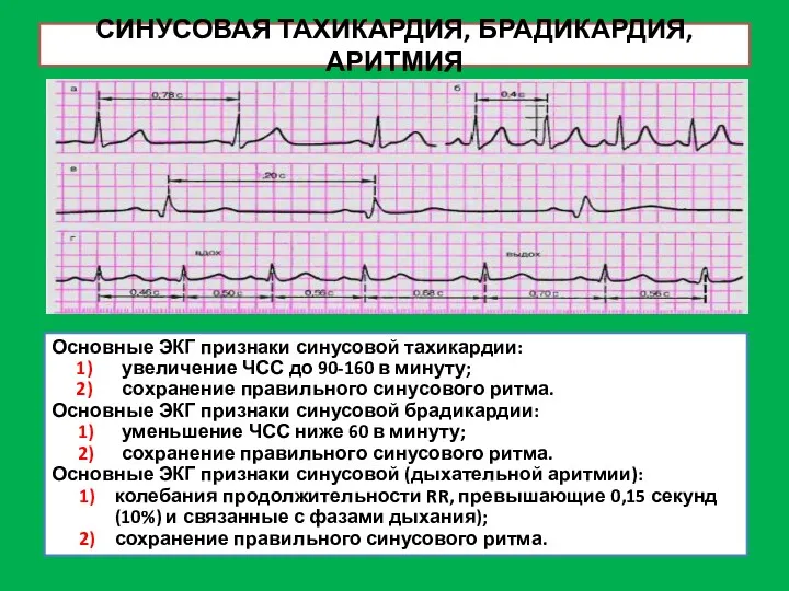 СИНУСОВАЯ ТАХИКАРДИЯ, БРАДИКАРДИЯ, АРИТМИЯ Основные ЭКГ признаки синусовой тахикардии: увеличение