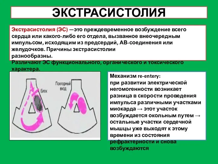 ЭКСТРАСИСТОЛИЯ Экстрасистолия (ЭС) —это преждевременное возбуждение всего сердца или какого-либо