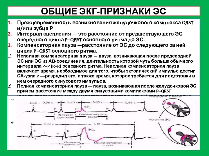 ОБЩИЕ ЭКГ-ПРИЗНАКИ ЭС Преждевременность возникновения желудочкового комплекса QRST и/или зубца