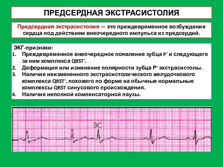 ПРЕДСЕРДНАЯ ЭКСТРАСИСТОЛИЯ Предсердная экстрасистолия — это преждевременное возбуждение сердца под