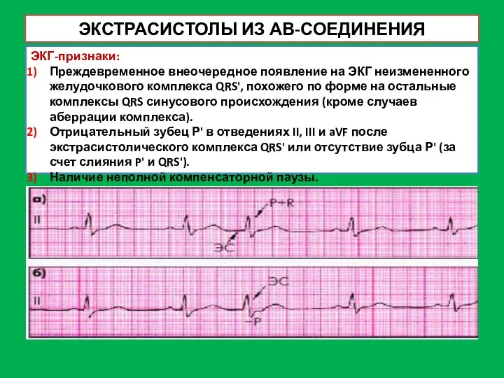 ЭКСТРАСИСТОЛЫ ИЗ АВ-СОЕДИНЕНИЯ ЭКГ-признаки: Преждевременное внеочередное появление на ЭКГ неизмененного