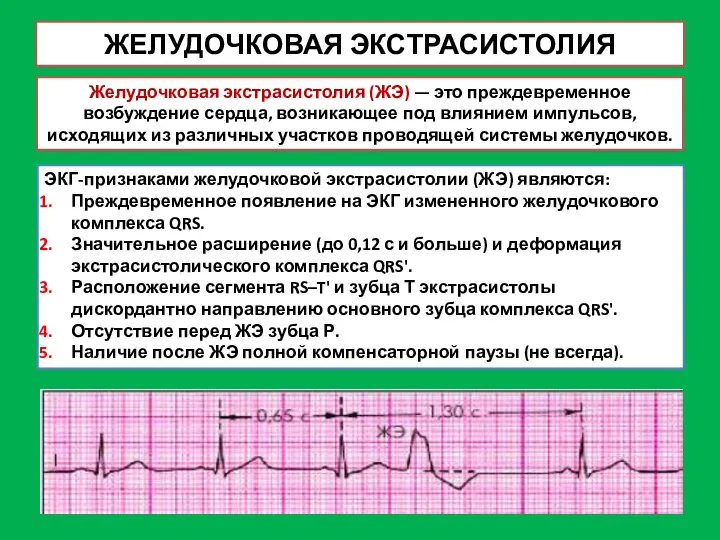 ЖЕЛУДОЧКОВАЯ ЭКСТРАСИСТОЛИЯ Желудочковая экстрасистолия (ЖЭ) — это преждевременное возбуждение сердца,