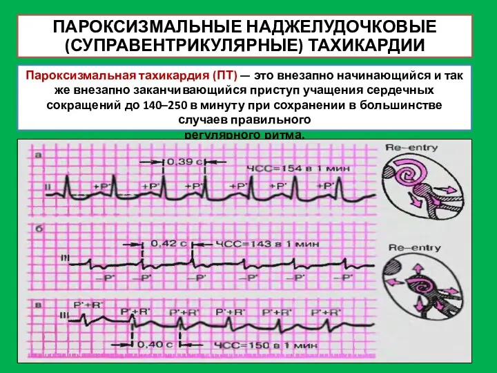 ПАРОКСИЗМАЛЬНЫЕ НАДЖЕЛУДОЧКОВЫЕ (СУПРАВЕНТРИКУЛЯРНЫЕ) ТАХИКАРДИИ Пароксизмальная тахикардия (ПТ) — это внезапно