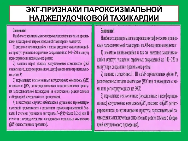 ЭКГ-ПРИЗНАКИ ПАРОКСИЗМАЛЬНОЙ НАДЖЕЛУДОЧКОВОЙ ТАХИКАРДИИ