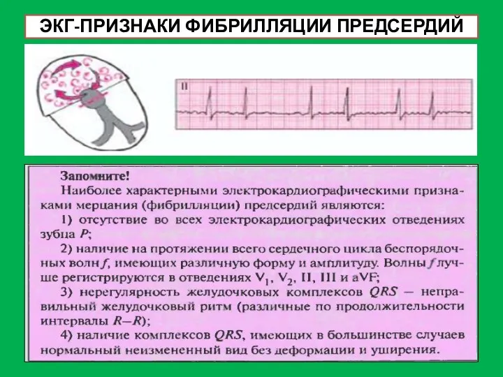 ЭКГ-ПРИЗНАКИ ФИБРИЛЛЯЦИИ ПРЕДСЕРДИЙ