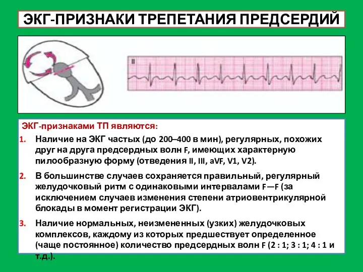 ЭКГ-ПРИЗНАКИ ТРЕПЕТАНИЯ ПРЕДСЕРДИЙ ЭКГ-признаками ТП являются: Наличие на ЭКГ частых