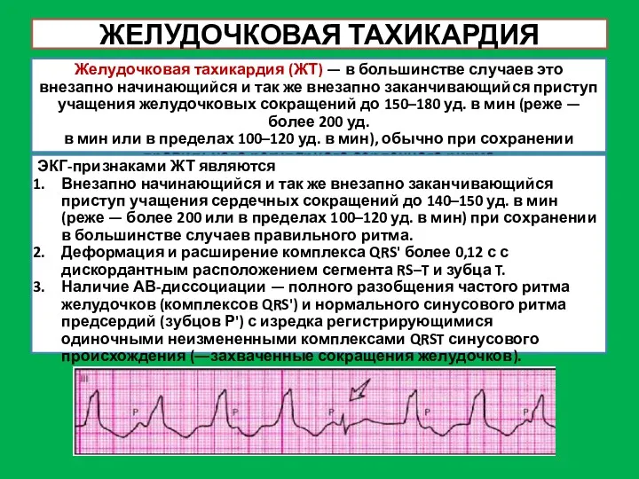 ЖЕЛУДОЧКОВАЯ ТАХИКАРДИЯ Желудочковая тахикардия (ЖТ) — в большинстве случаев это