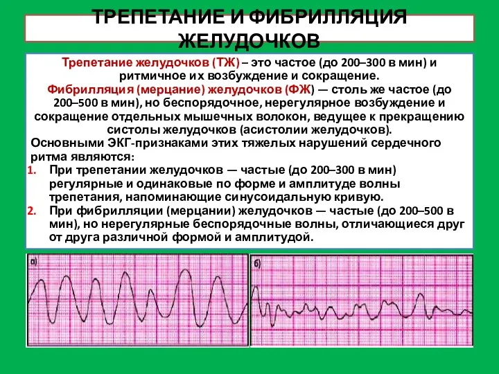 ТРЕПЕТАНИЕ И ФИБРИЛЛЯЦИЯ ЖЕЛУДОЧКОВ Трепетание желудочков (ТЖ) – это частое