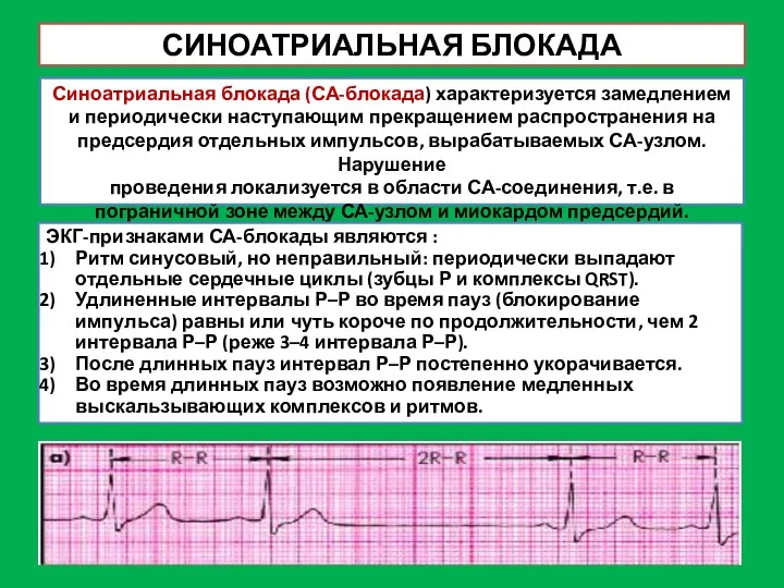 СИНОАТРИАЛЬНАЯ БЛОКАДА Синоатриальная блокада (СА-блокада) характеризуется замедлением и периодически наступающим