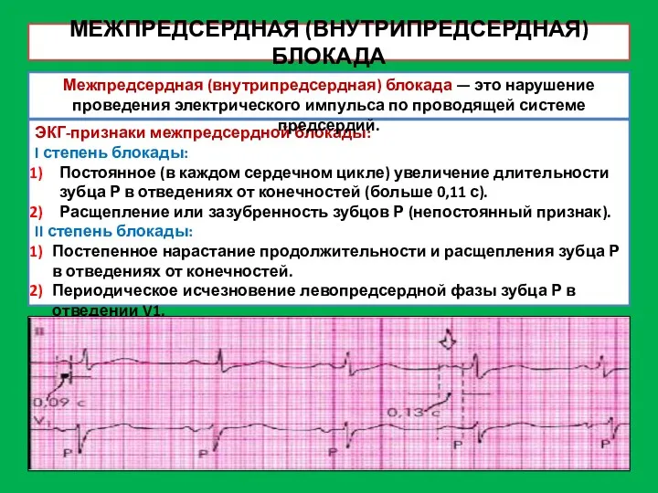 МЕЖПРЕДСЕРДНАЯ (ВНУТРИПРЕДСЕРДНАЯ) БЛОКАДА ЭКГ-признаки межпредсердной блокады: I степень блокады: Постоянное