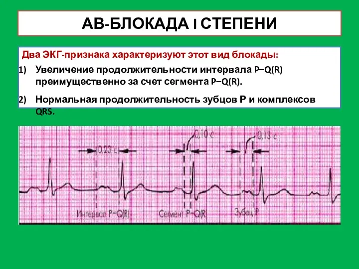 АВ-БЛОКАДА I СТЕПЕНИ Два ЭКГ-признака характеризуют этот вид блокады: Увеличение