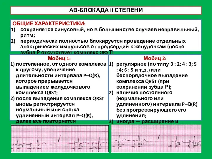 АВ-БЛОКАДА II СТЕПЕНИ ОБЩИЕ ХАРАКТЕРИСТИКИ: сохраняется синусовый, но в большинстве