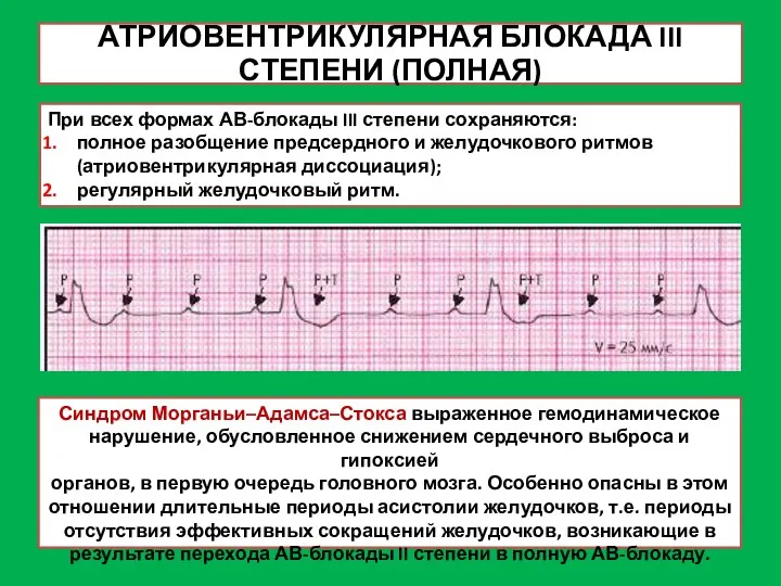 АТРИОВЕНТРИКУЛЯРНАЯ БЛОКАДА III СТЕПЕНИ (ПОЛНАЯ) При всех формах АВ-блокады III