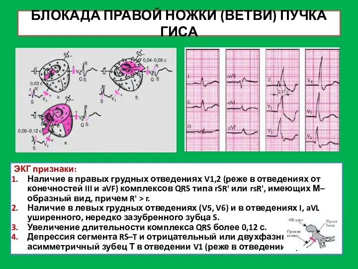 БЛОКАДА ПРАВОЙ НОЖКИ (ВЕТВИ) ПУЧКА ГИСА ЭКГ признаки: Наличие в