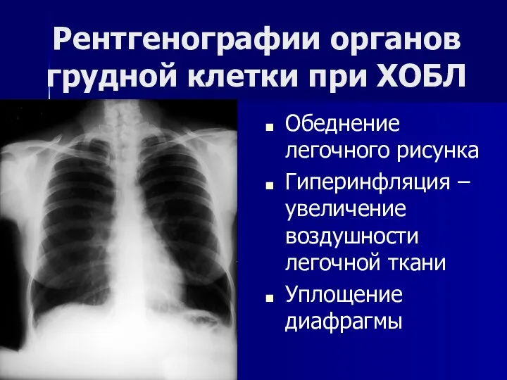 Рентгенографии органов грудной клетки при ХОБЛ Обеднение легочного рисунка Гиперинфляция