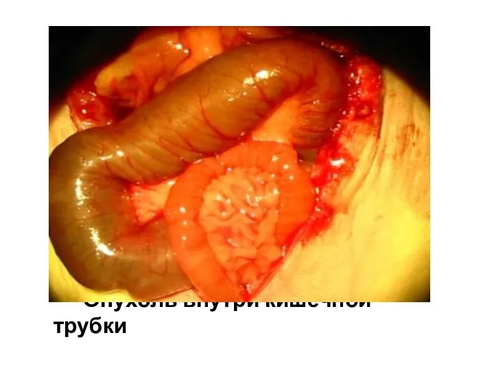 Опухоль внутри кишечной трубки