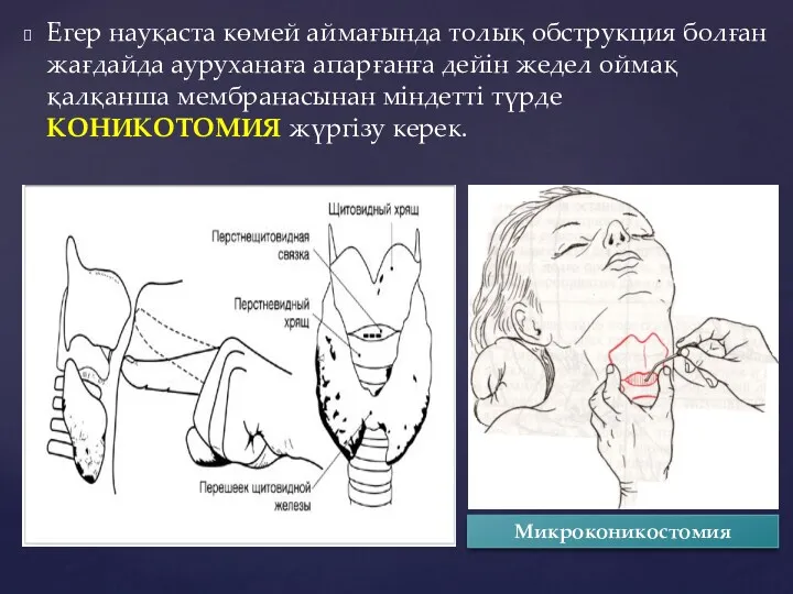 Егер науқаста көмей аймағында толық обструкция болған жағдайда ауруханаға апарғанға